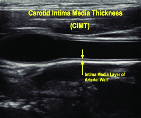 ultrasound measurement of carotid artery intima-media thickness|carotid intima media thickness guidelines.